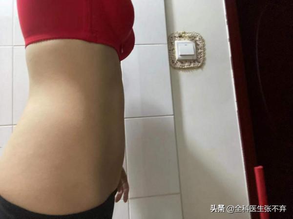 度拉糖肽減肥再記 度拉糖肽減肥再記