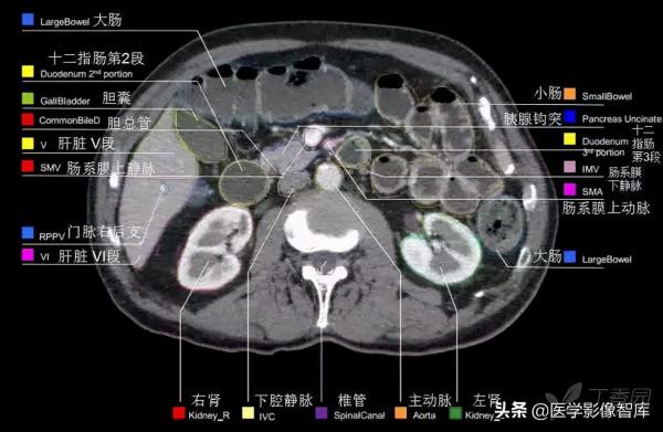CT斷層解剖圖譜最全總結「推薦收藏」 CT斷層解剖圖譜最全總結「推薦收藏」