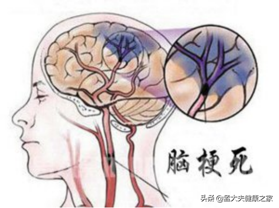 為何農村因腦梗死的人越來越多？醫生坦言：與3大因素有關