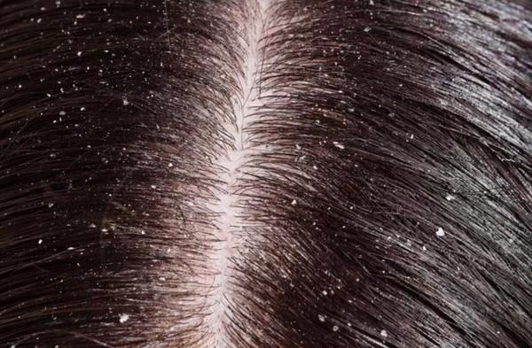 頭髮根部的小白點是什麼?掉了不能長出頭髮? 頭髮根部的小白點是什麼?掉了不能長出頭髮?