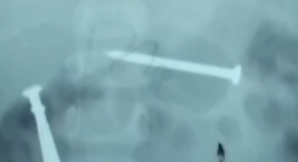 真實故事：陝西1歲幼童患怪病，身體長出鐵釘，醫生查明真相