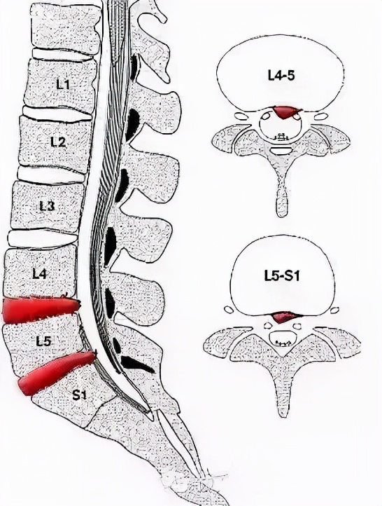 為什麼多數腰椎間盤突出症患者都是腰4/5“愛”突出？