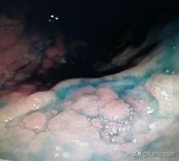 「真實案例」31歲偶爾腹脹，一次意外的胃鏡，竟然救了她一命