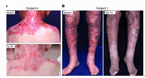 幹細胞拯救不美麗的&OpenCurlyDoubleQuote;蝴蝶病&rdquo;，使面板長期保持穩定性