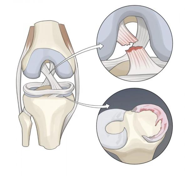 平時不運動,週末去健身房玩命,你的膝關節真的準備好了嗎? 平時不運動,週末去健身房玩命,你的膝關節真的準備好了嗎?