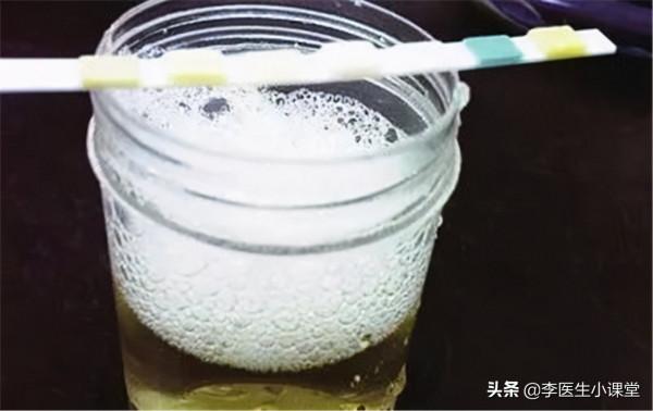 腎功能受損有哪些徵兆？醫生：除了泡沫尿，這幾種症狀也要警惕