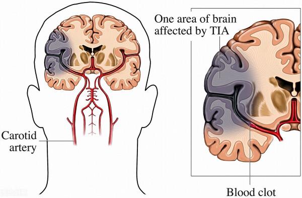 突發腦梗失去自理能力！4類人最易腦梗，知曉預兆和風險，早預防
