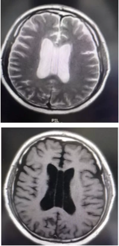 “第五腦室”是透明隔腔嗎? “第五腦室”是透明隔腔嗎?