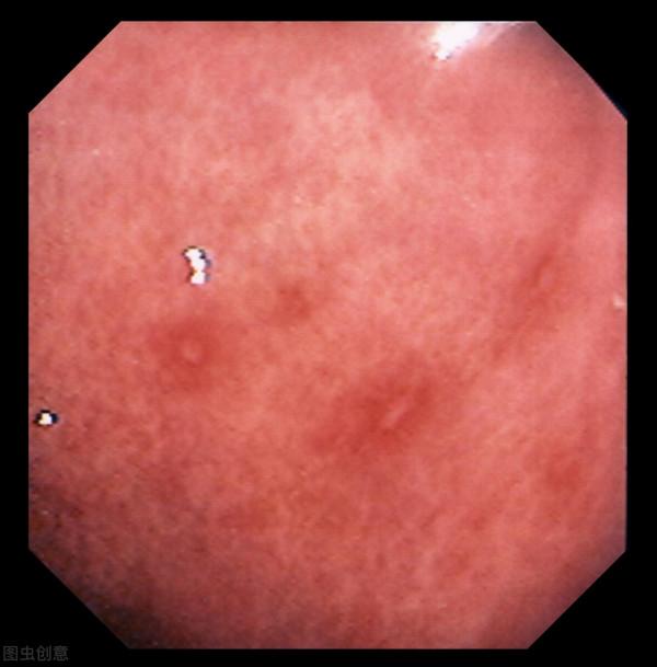 男子腹痛嘔血，以為胃潰瘍，確診時醫生冒汗：這病幾分鐘就可致命