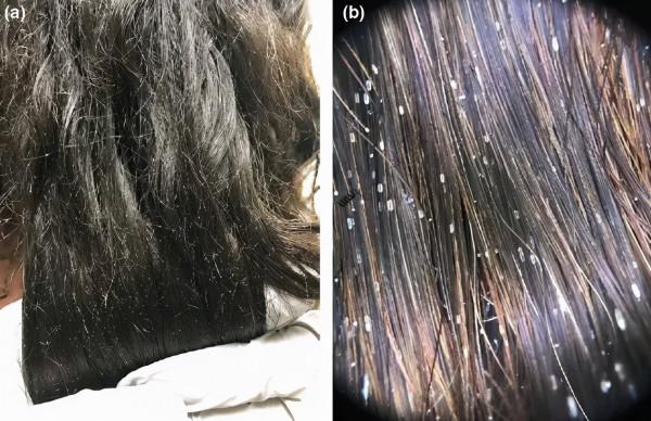 頭髮根部的小白點是什麼?掉了不能長出頭髮? 頭髮根部的小白點是什麼?掉了不能長出頭髮?