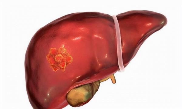 醫生提醒：乙肝患者若有以下四種症狀，要及時引起注意，不可大意