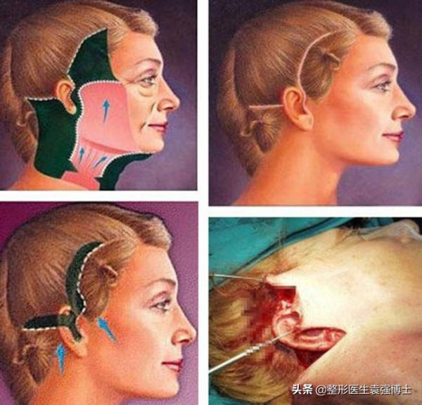 拉皮手術“落伍”了，早都“過時”了？