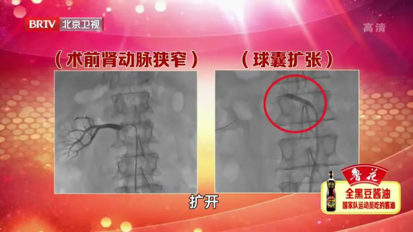 血管&OpenCurlyDoubleQuote;爆裂&rdquo;之前，可能會有這些症狀！自測方法也別錯過