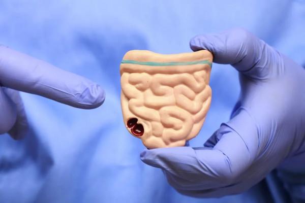 最容易被忽視的大腸癌篩查