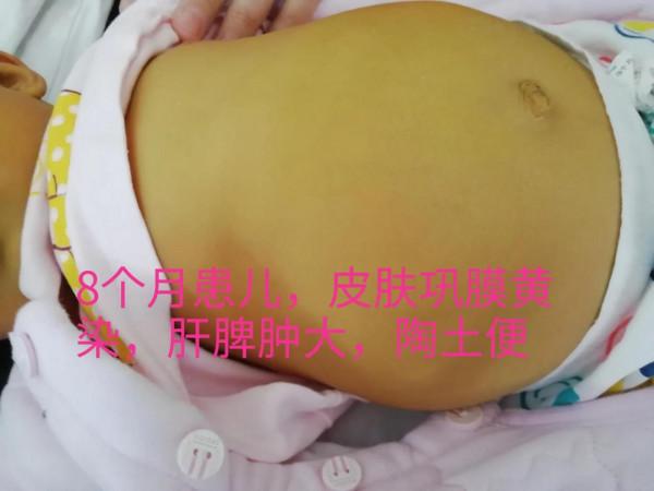 淺析幼兒黃疸之膽道閉鎖的超聲表現