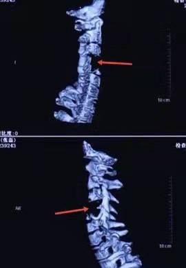 脊索瘤&OpenCurlyDoubleQuote;掏空&rdquo;兩節頸椎，如何搭建&OpenCurlyDoubleQuote;人造橋樑&rdquo;支撐脊柱？