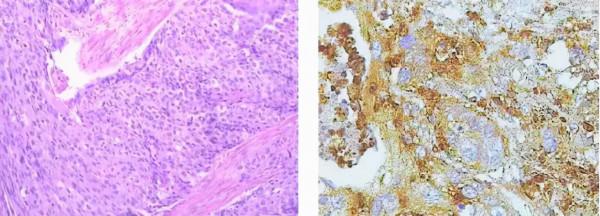 經典病例分享 | 多學科綜合治療區域性晚期食管癌完全緩解一例