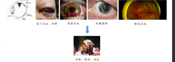 眼外傷後的院外處理，您做對了嗎？