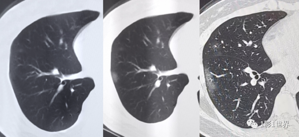 影像檢查“未見異常”就說明沒事嗎？