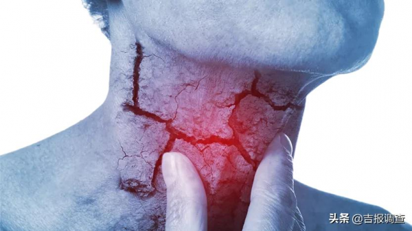 中醫專家提醒：“牛黃解毒”降實火，虛火不能吃！外用也能治病