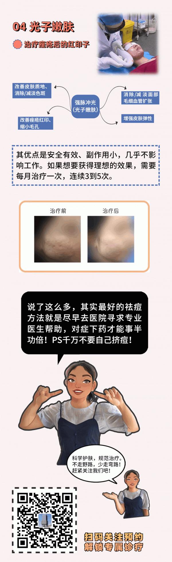 如何優雅地跟痘痘說拜拜