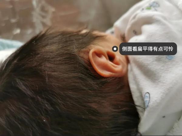 寶寶剛出生耳廓畸形,現在長成什麼樣了? 寶寶剛出生耳廓畸形,現在長成什麼樣了?