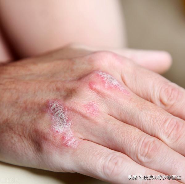 長粉刺、毛孔粗大都可以用它—維A酸乳膏 長粉刺、毛孔粗大都可以用它—維A酸乳膏