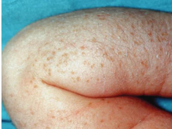 新生兒一過性面板病（上）