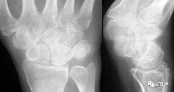 贊！腕關節X線高畫質解剖+腕骨脫位典型病例