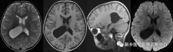 在側腦室三角區看到佔位，要想到這8種腫瘤