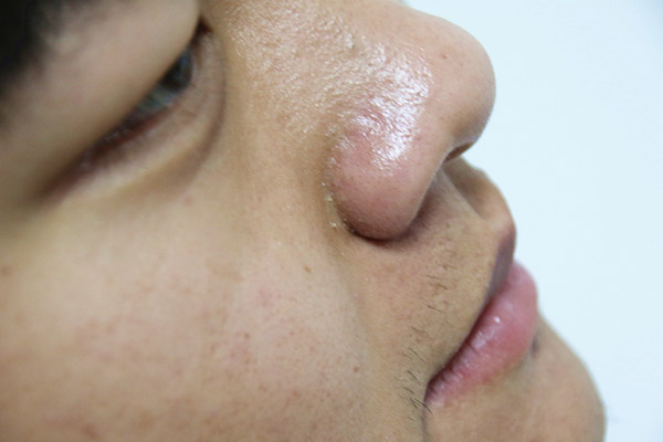 肝臟病變並不沉默，面板出現3種變化，別以為是面板問題