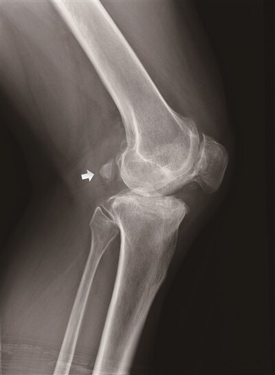 膕窩後側疼痛?當心是腓腸豆骨綜合徵 膕窩後側疼痛?當心是腓腸豆骨綜合徵