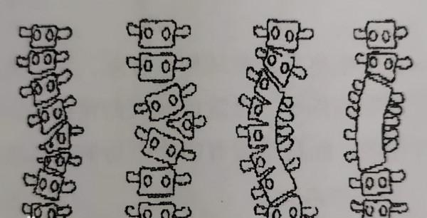 先天性脊柱側彎是怎麼引起的？