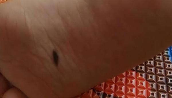 醫生提醒：若黑痣長在這4個部位，要密切關注，及早做檢查