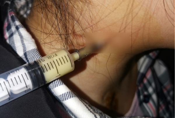 25歲女白領脖子上長出小包塊，一查竟是淋巴結結核