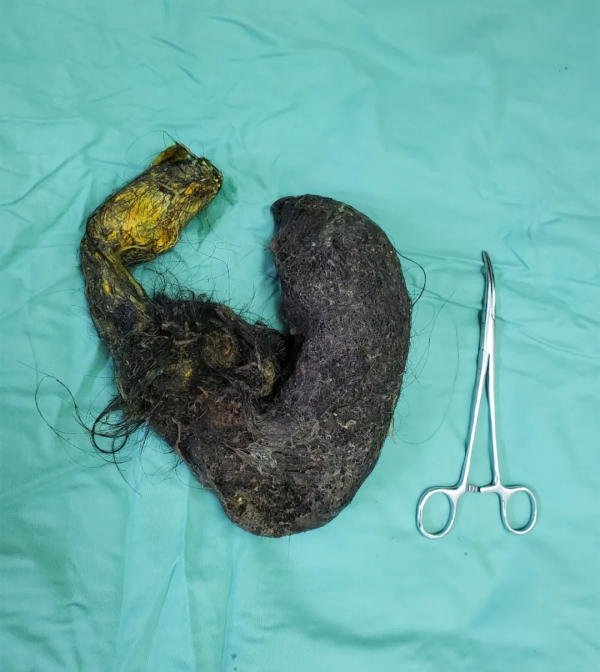 廣西一13歲小女孩反覆腹痛半月餘，醫生從其胃裡取出一大團頭髮