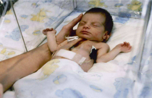 1984年，美國博士將“狒狒”的心臟，移植到女嬰身上，後來怎樣了