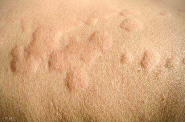 冬天常見面板問題的辨別治療與預防 冬天常見面板問題的辨別治療與預防