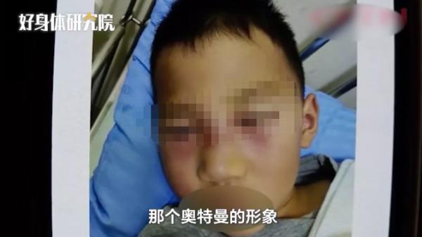 5歲男孩挖鼻孔,竟把臉挖腫…醫生提醒:臉上這部位別亂碰 5歲男孩挖鼻孔,竟把臉挖腫…醫生提醒:臉上這部位別亂碰