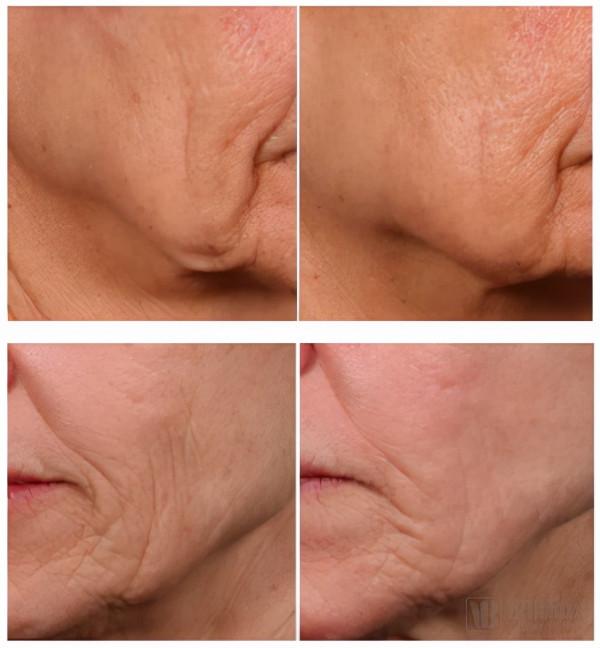 ARCH Venture連投三輪，面板抗衰技術公司Cytrellis即將步入收穫期