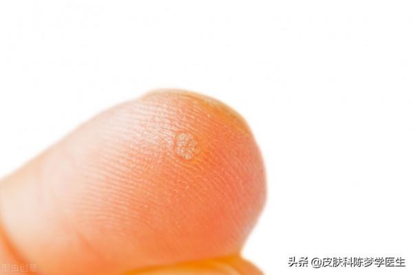 長粉刺、毛孔粗大都可以用它—維A酸乳膏 長粉刺、毛孔粗大都可以用它—維A酸乳膏