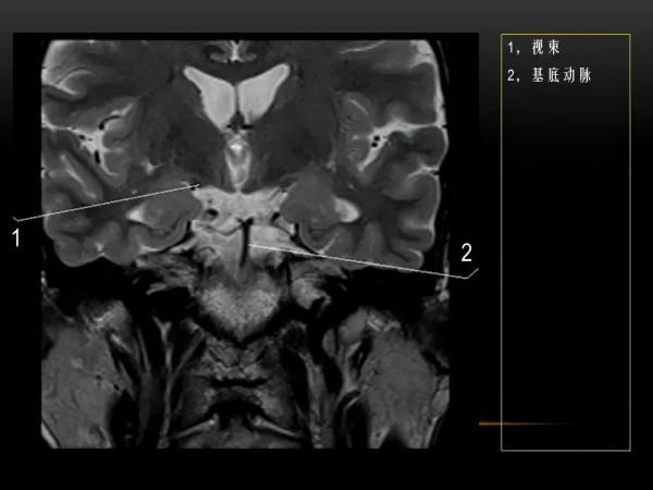 MRI下眼部及鼻竇解剖