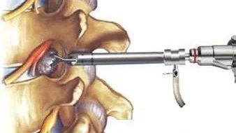 真的嗎?背上打個孔,十多年的腰腿痛就好了 真的嗎?背上打個孔,十多年的腰腿痛就好了