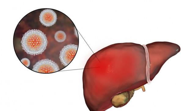 肝癌早期不痛不癢，提醒：一旦出現“2黃1紅”，別拖了，早查肝CT