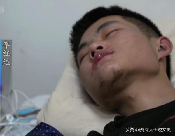 2021年小夥喝下整瓶百草枯，入院18天有好轉，醫生暗示：準備後事