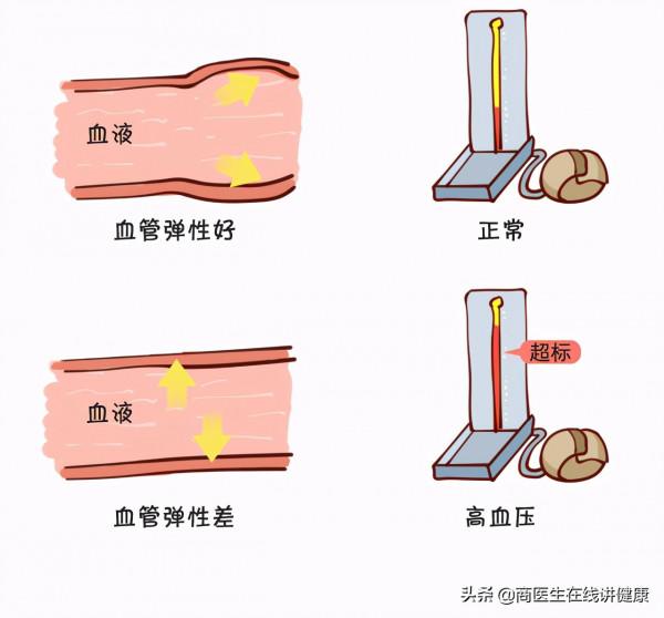有高血壓的人要注意了，醫生：出現這3種狀況當心腦出血，要警惕