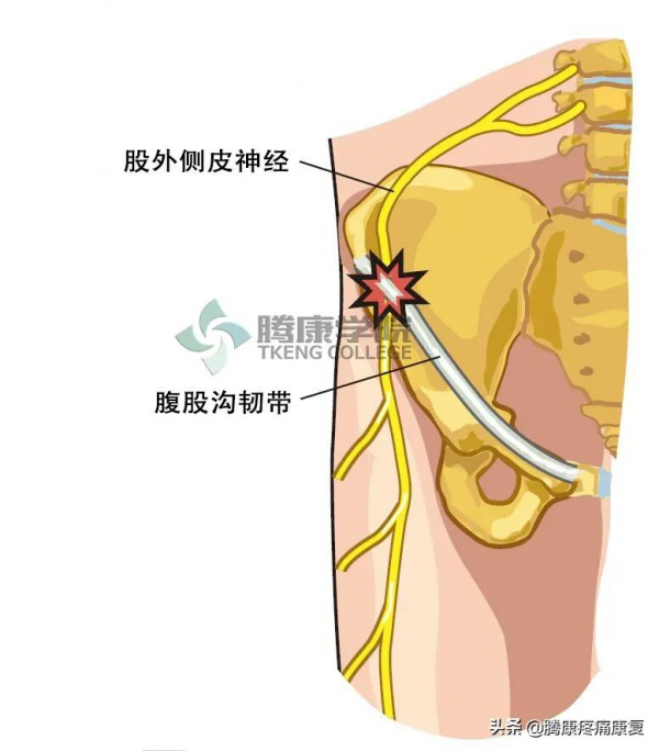 神經受壓產生的不只有疼痛,還有情緒和精神的改變 神經受壓產生的不只有疼痛,還有情緒和精神的改變