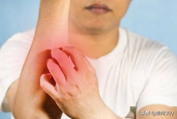 溼疹癢得難受,小妙招幫你解憂,告別反覆發作的溼疹 溼疹癢得難受,小妙招幫你解憂,告別反覆發作的溼疹