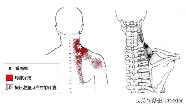 脖子又酸又痛！怎樣緩解頸肩痠痛？這裡有答案