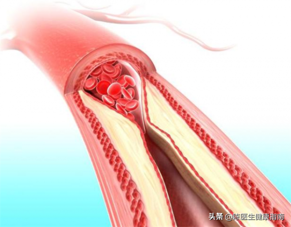 58歲蔣叔查出慢性腎衰竭,原因:擅自將辛伐他汀換成瑞舒伐他汀 58歲蔣叔查出慢性腎衰竭,原因:擅自將辛伐他汀換成瑞舒伐他汀